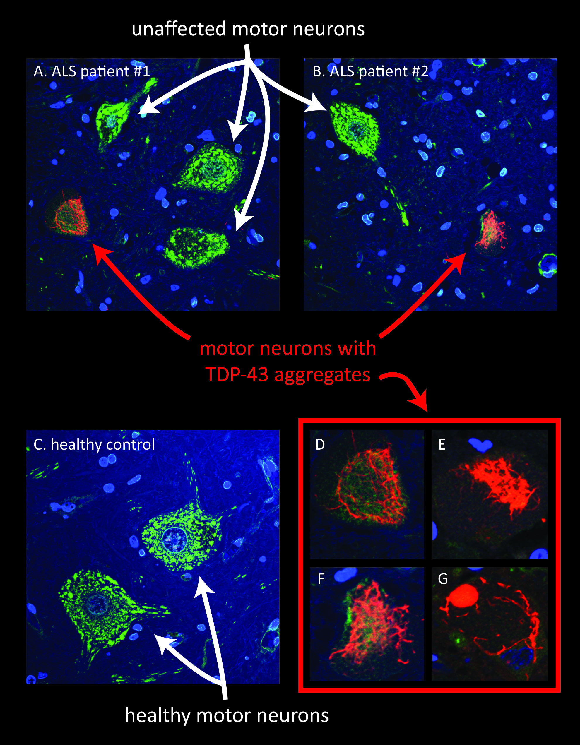 amyotrophic lateral sclerosis essay example 6 Free essay: amyotrophic lateral sclerosis is a motor neuron type disease the disease was first discovered in 1869 by french neurologist jean-martin charcot. amyotrophic lateral sclerosis essay example 6 Free essay: amyotrophic lateral sclerosis is a motor neuron type disease the disease was first discovered in 1869 by french neurologist jean-martin charcot.